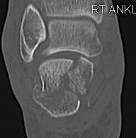 Calcaneal Fracture Coronal CT